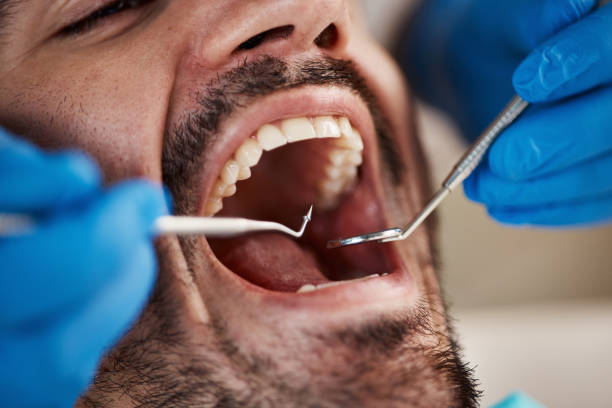 Best Knocked-Out Tooth (Avulsed Tooth) Treatment in White Sulphur Springs, WV